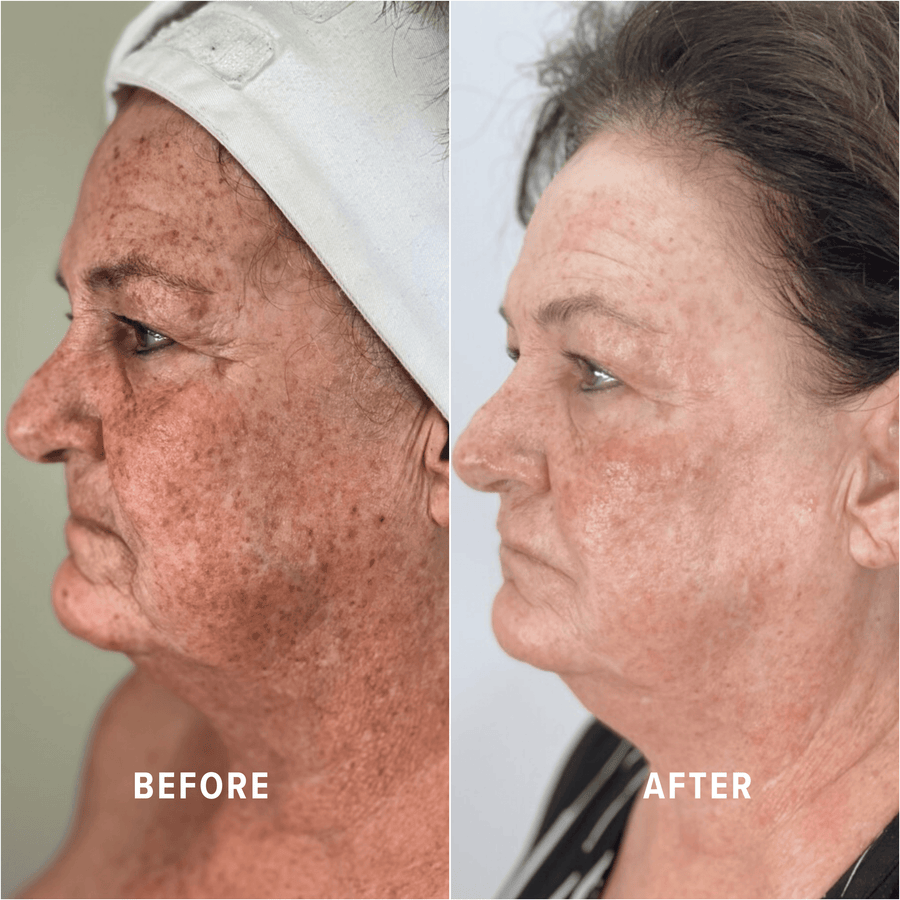 A Boho client's skin before and after treatment
