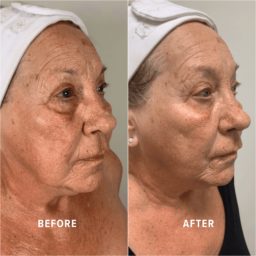 A Boho client's skin before and after treatment