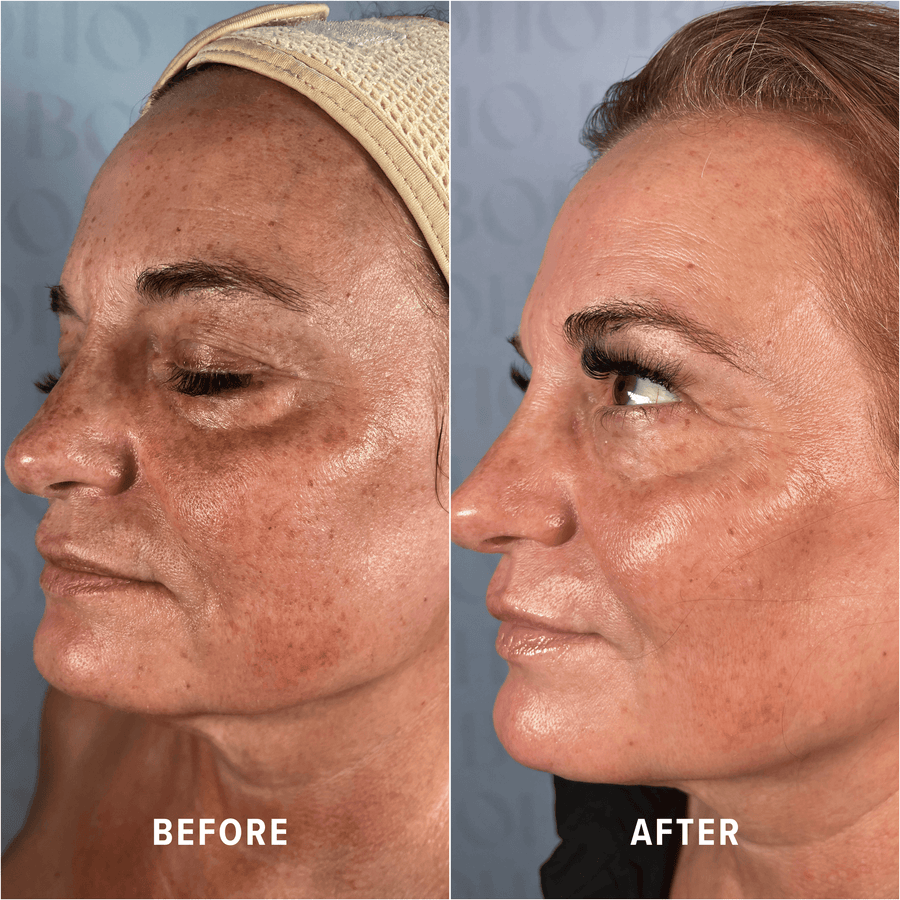 A Boho client's skin before and after treatment