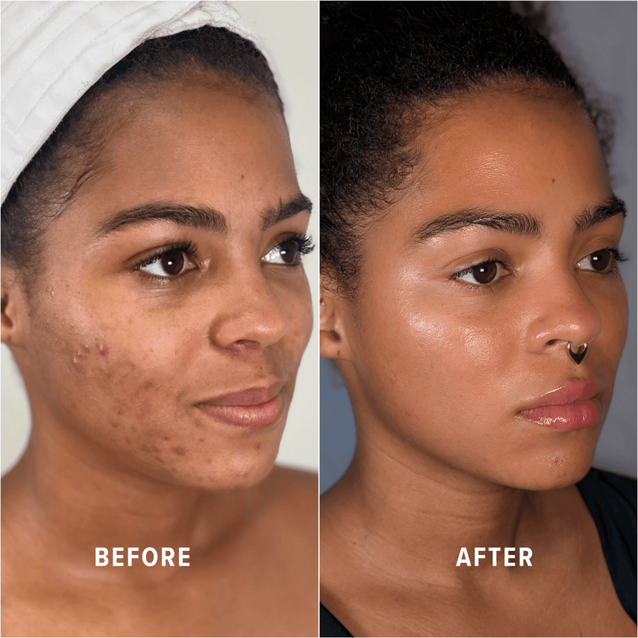 A Boho client's skin before and after treatment