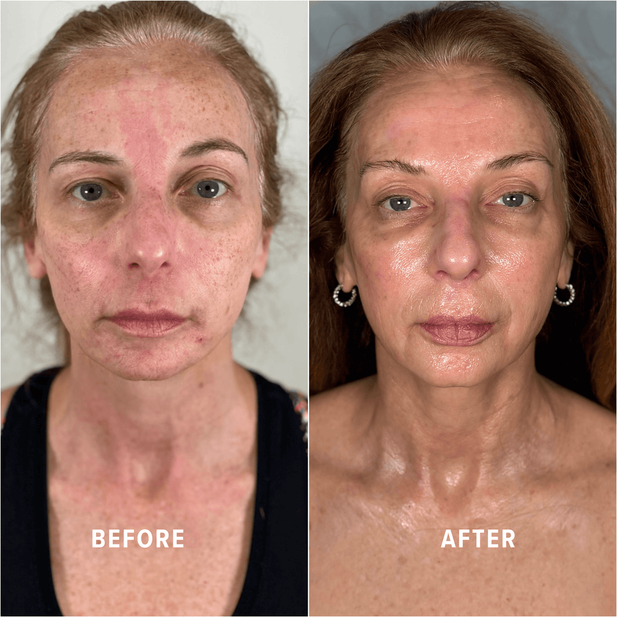 A Boho client's skin before and after treatment