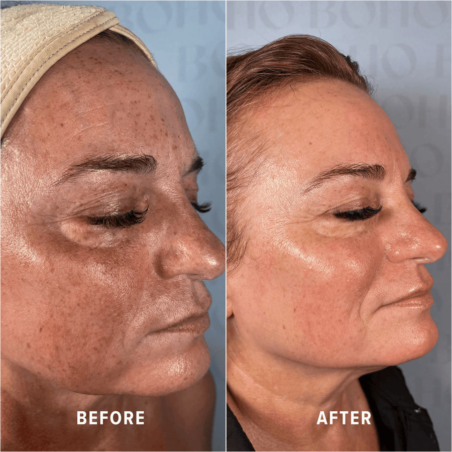 A Boho client's skin before and after treatment