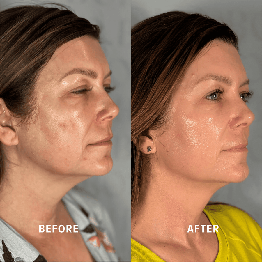 A Boho client's skin before and after treatment