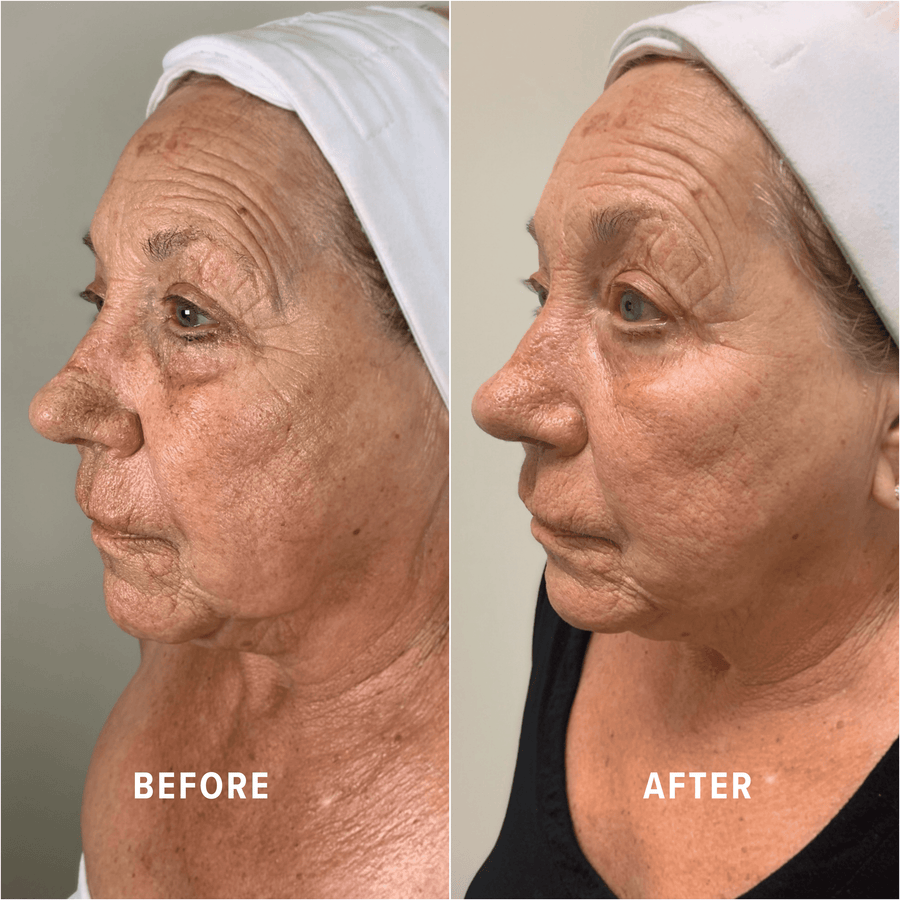 A Boho client's skin before and after treatment