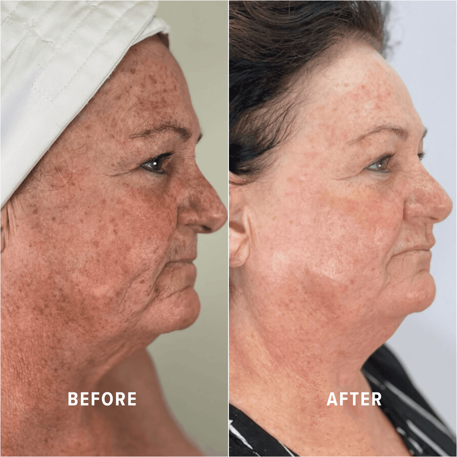 A Boho client's skin before and after treatment