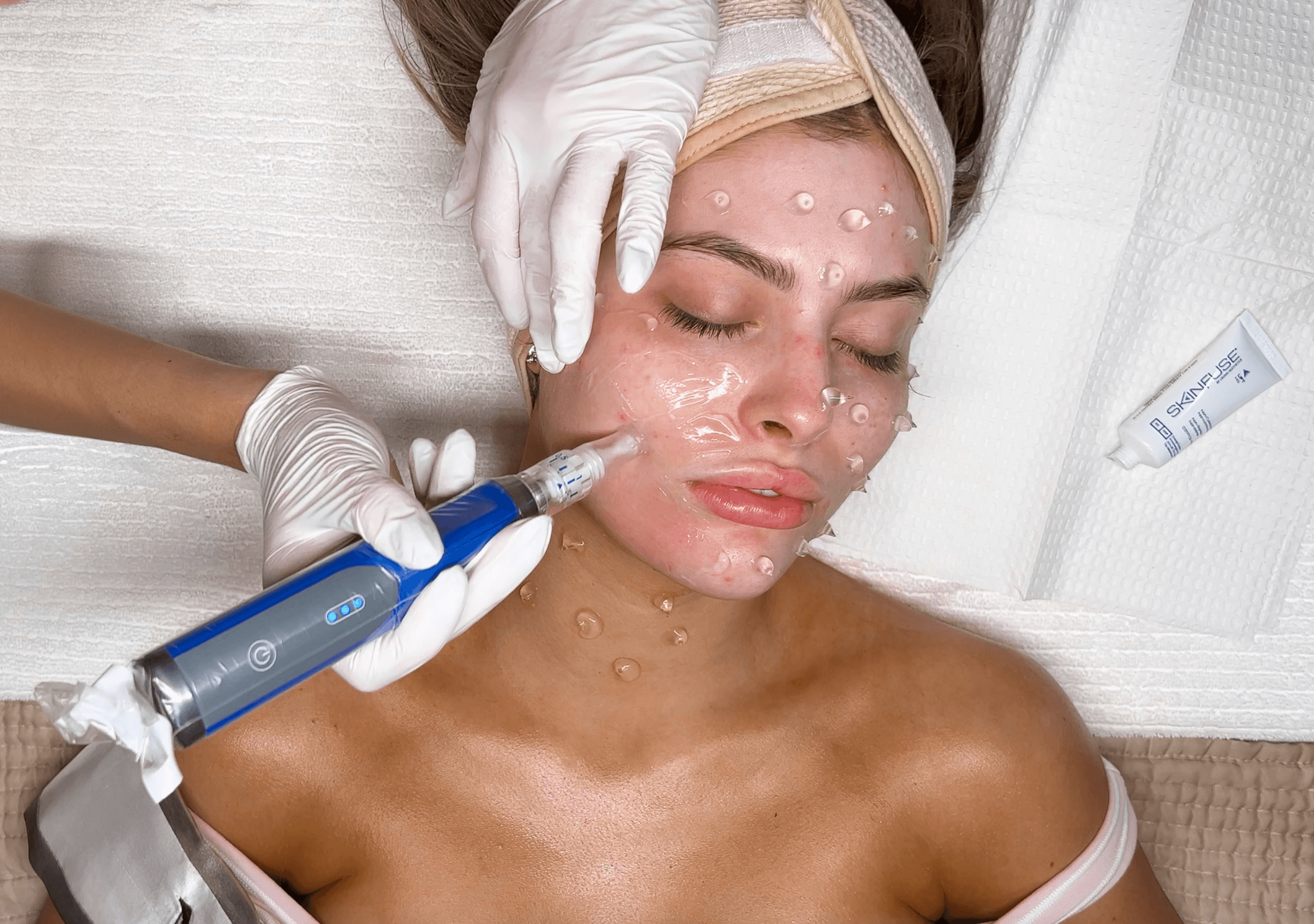 A provider in white gloves microneedling a resting guest’s cheek with a SkinPen