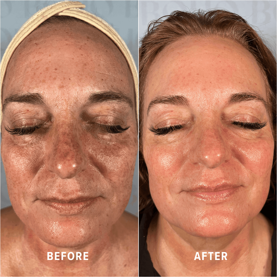 A Boho client's skin before and after treatment