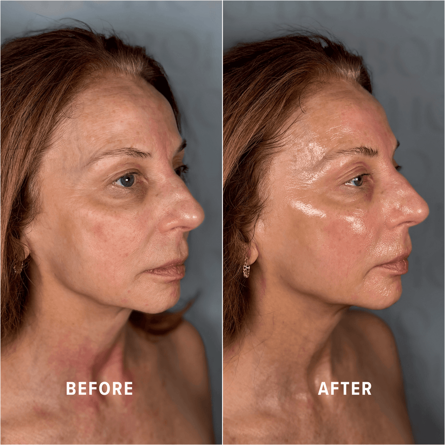 A Boho client's skin before and after treatment
