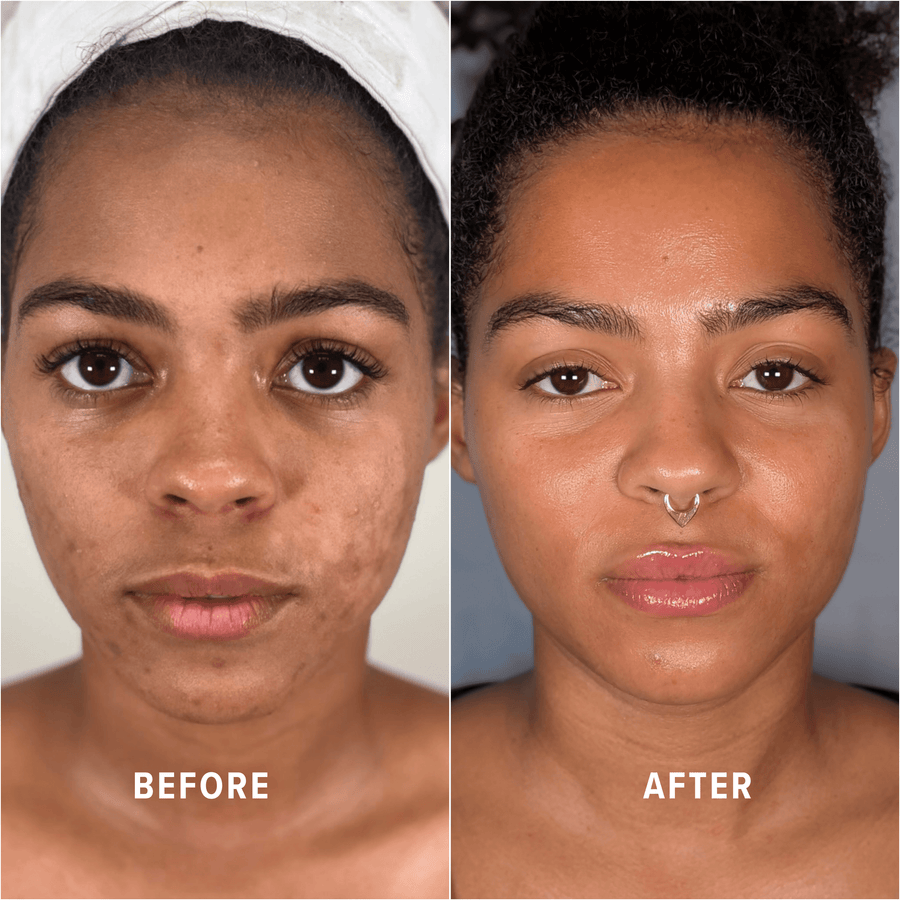A Boho client's skin before and after treatment