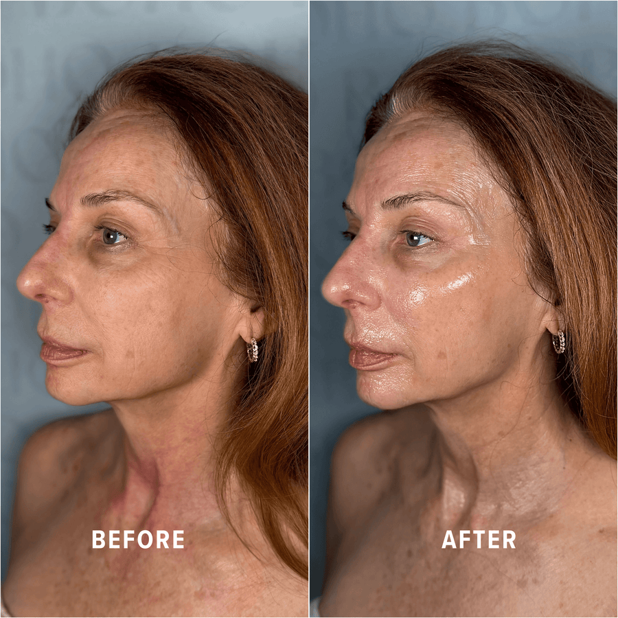 A Boho client's skin before and after treatment