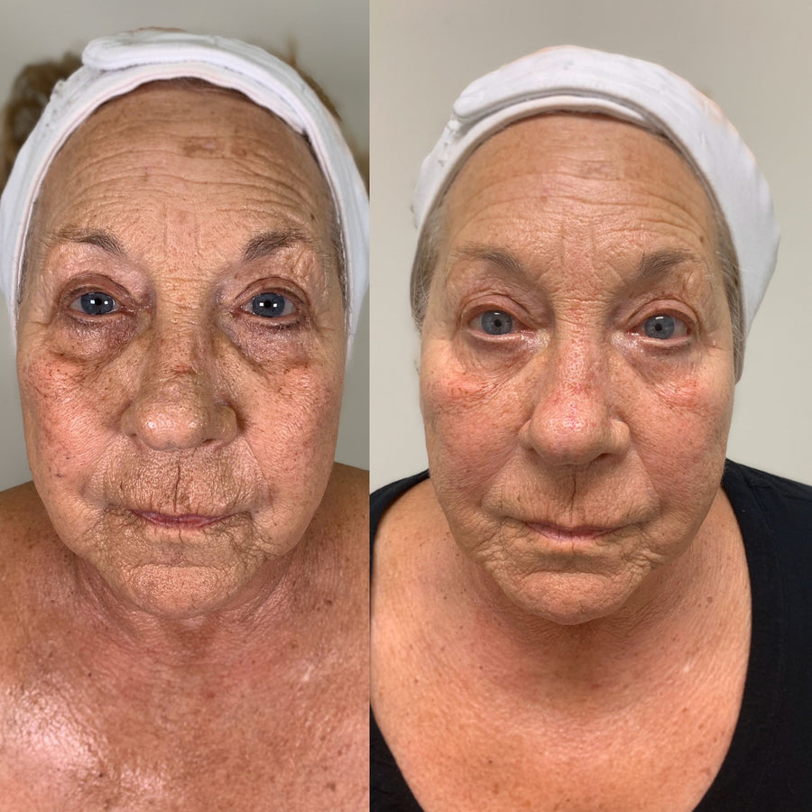 A Boho client's skin before and after treatment