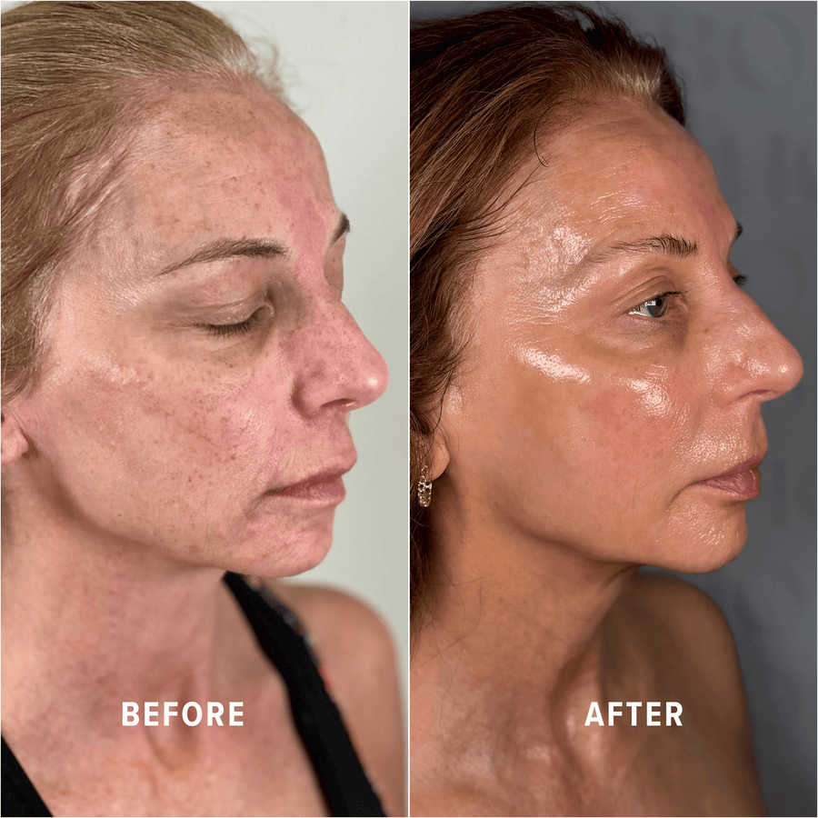 A Boho client's skin before and after treatment