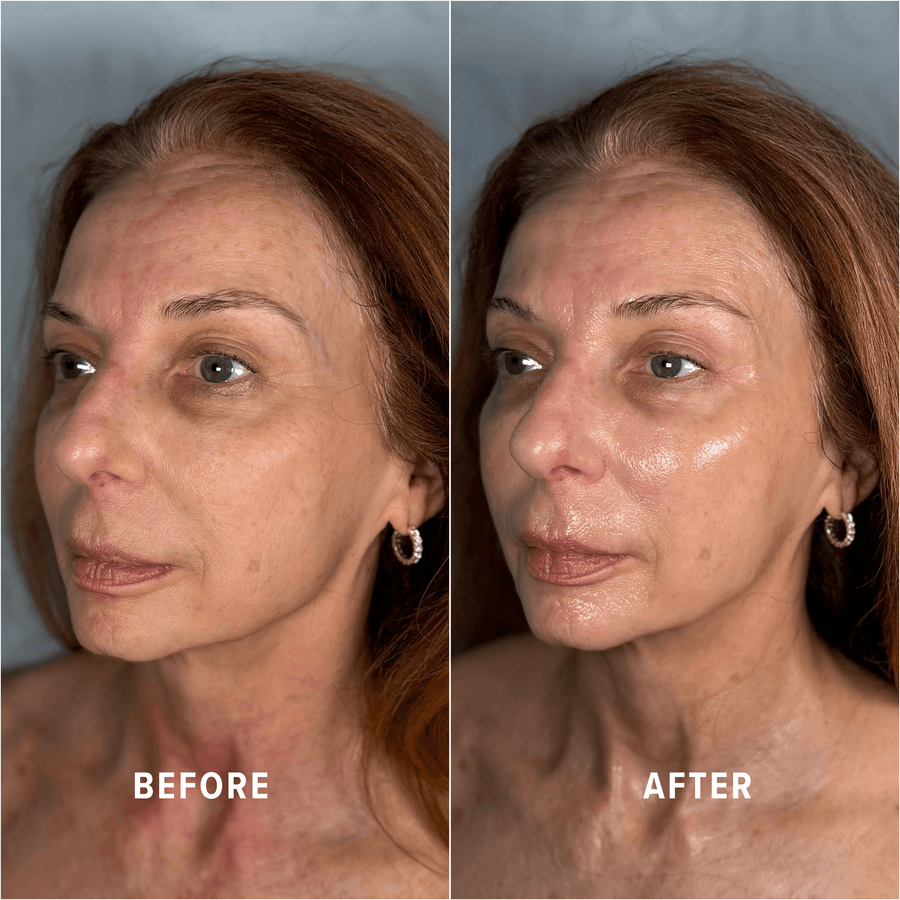 A Boho client's skin before and after treatment