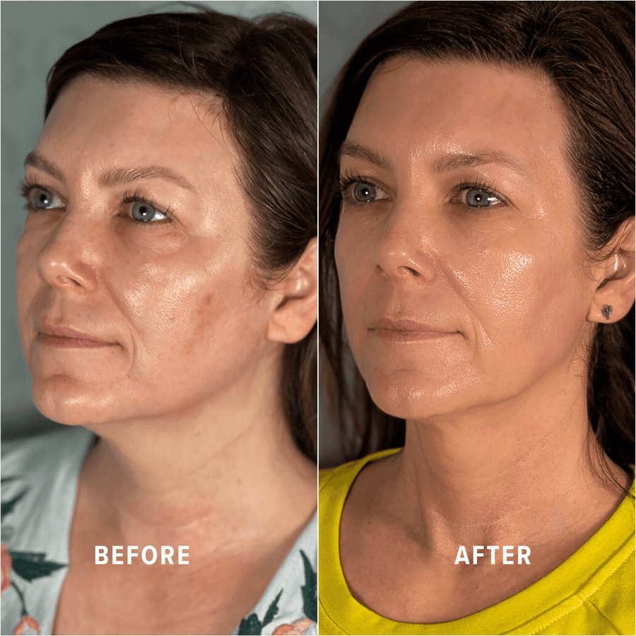 A Boho client's skin before and after treatment