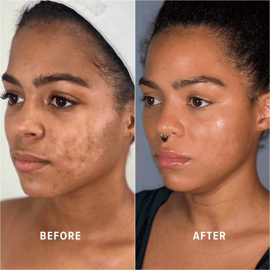 A Boho client's skin before and after treatment