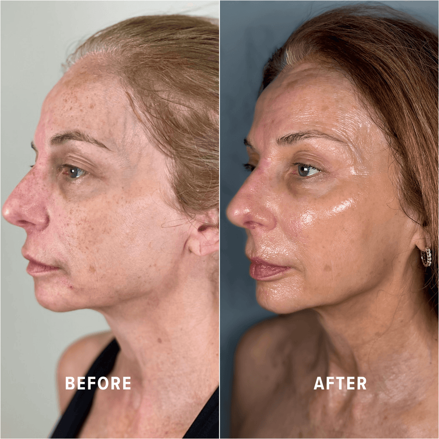 A Boho client's skin before and after treatment