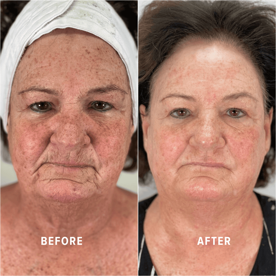 A Boho client's skin before and after treatment