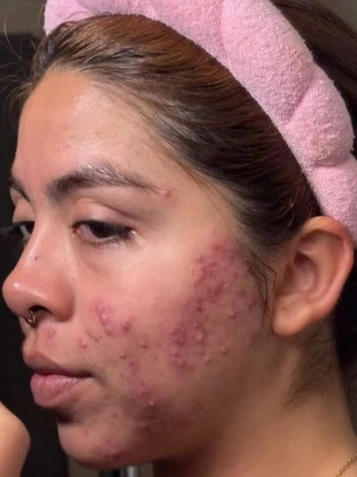Close-up of a client’s cheek and jaw with active acne, on day 1
