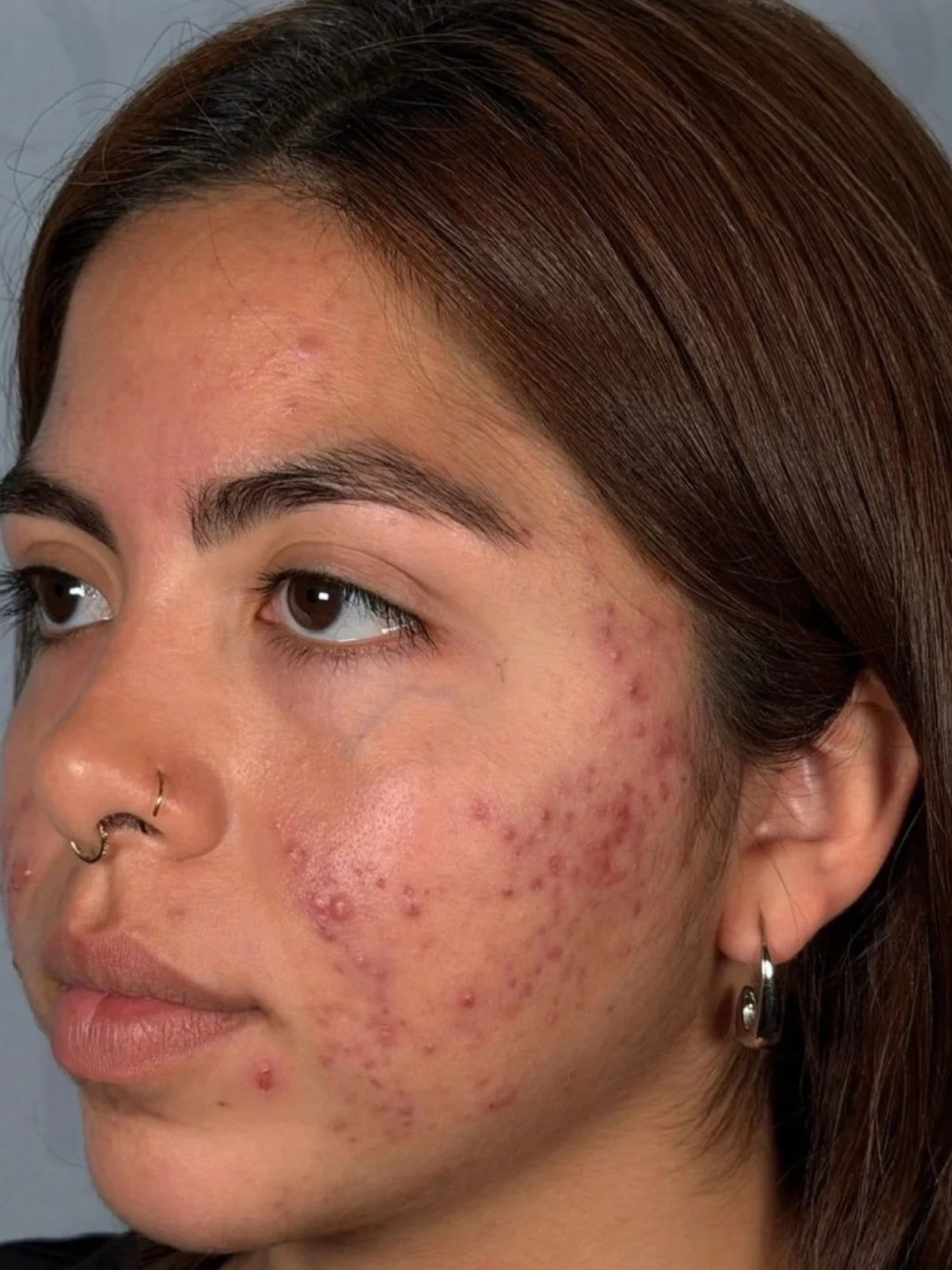 The same client’s face in profile, progress photo 1