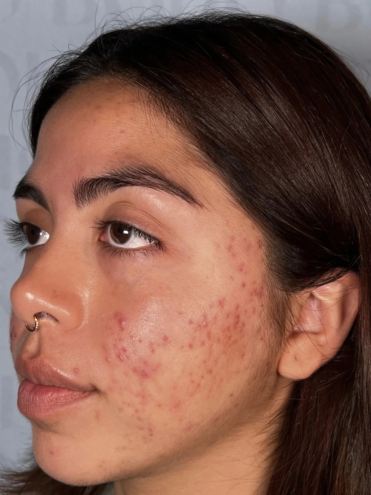 The same client’s face in profile, progress photo 2