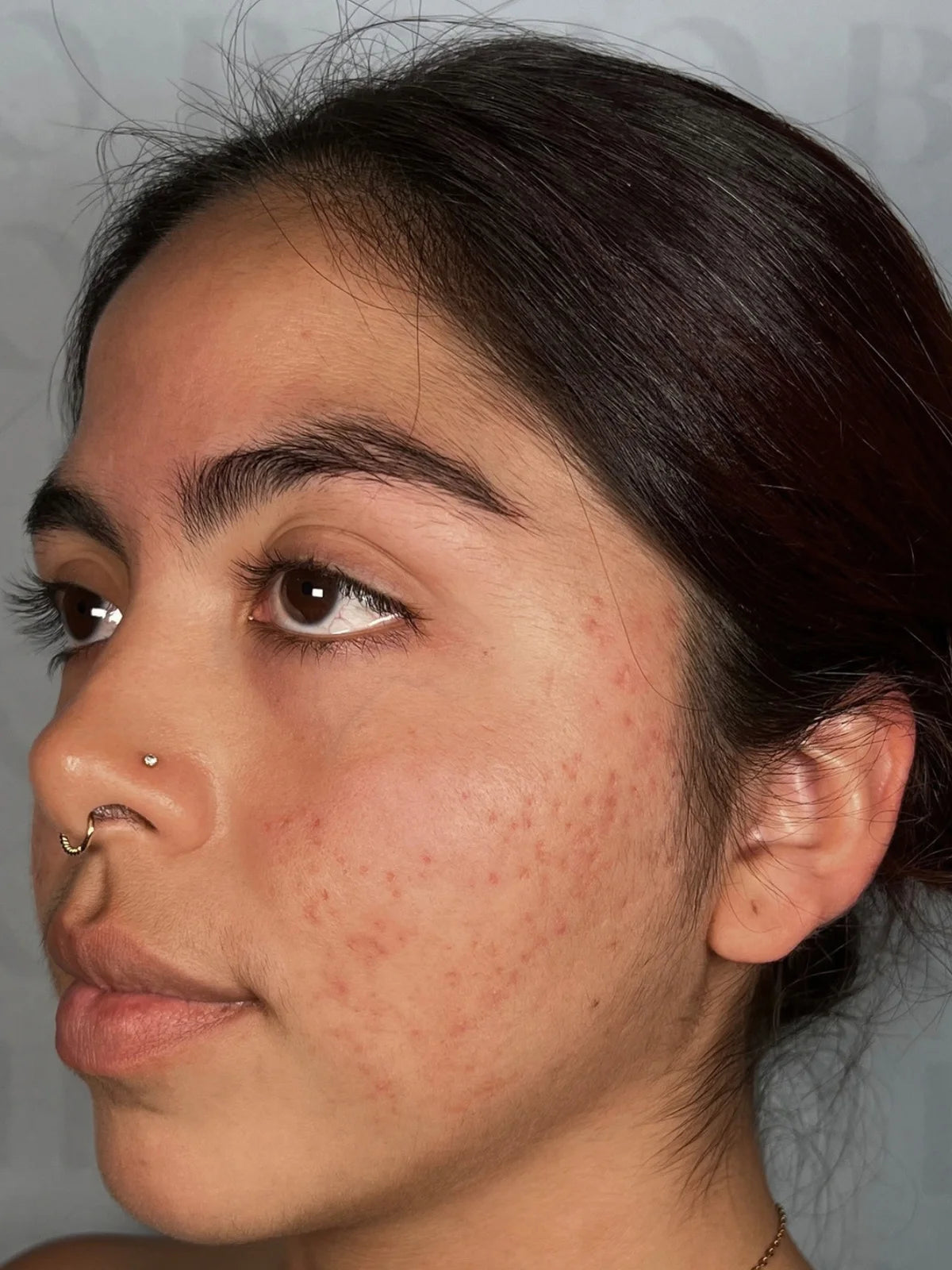 The same client’s face in profile, progress photo 3