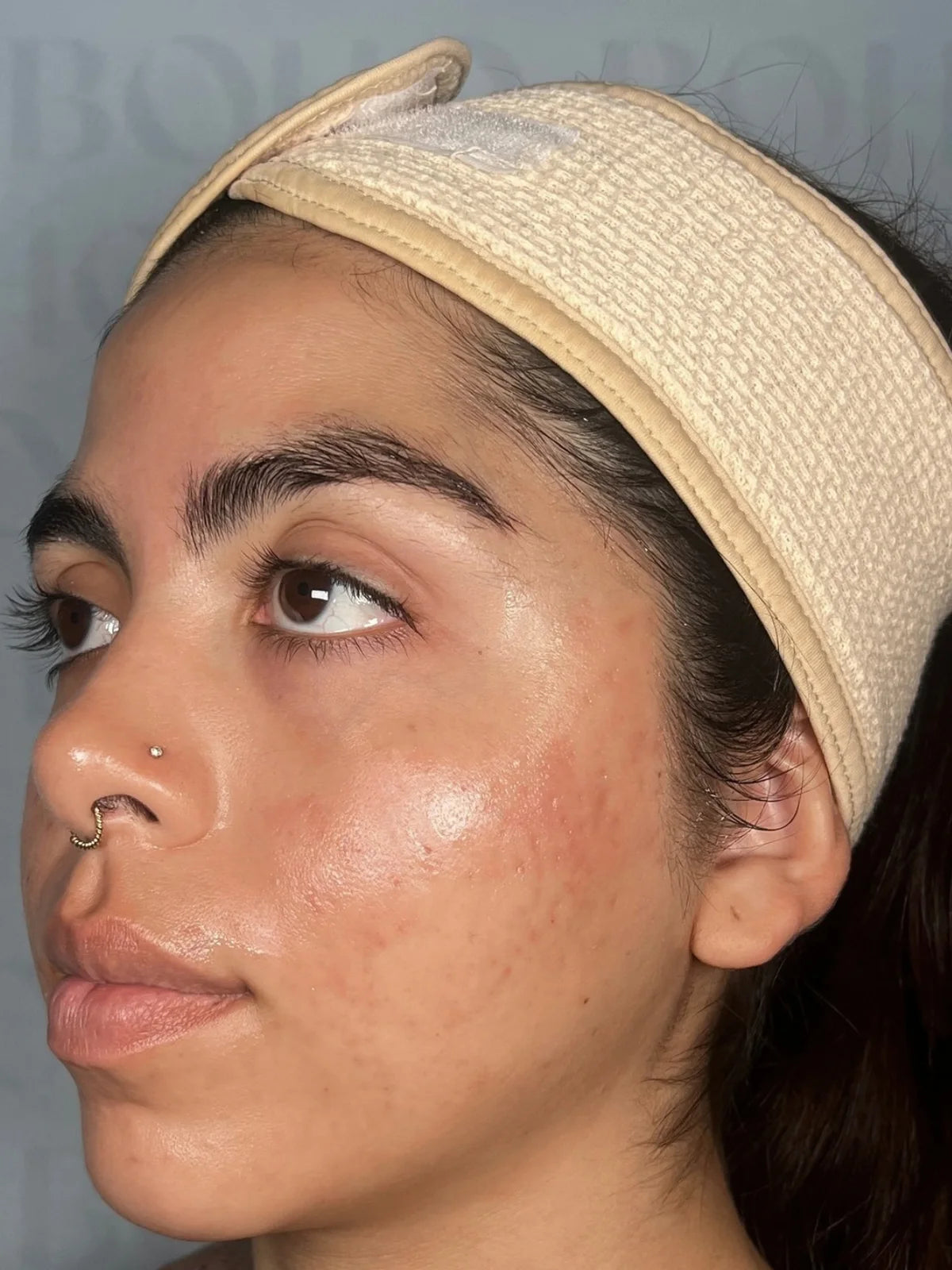 The same client’s face in profile, progress photo 4