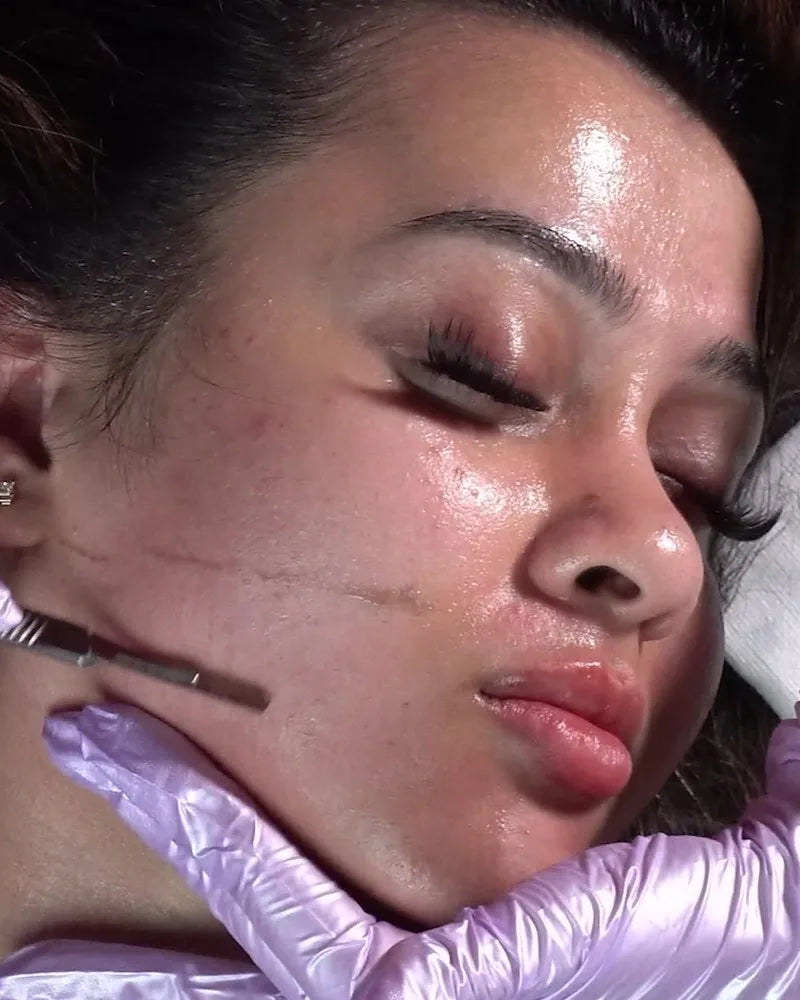 An esthetician in lavender gloves dermaplaning along a resting guest's jawline